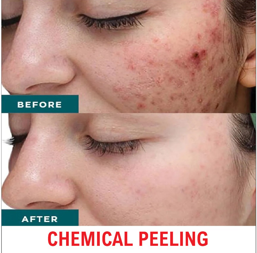 Laser Treatment
